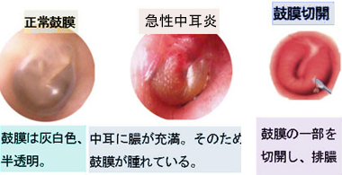 中耳炎について 医療法人 野上耳鼻咽喉科医院